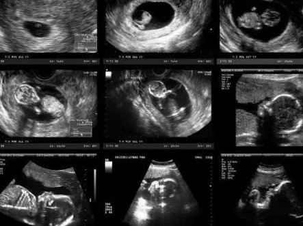 确诊为免疫性不孕能在青铜峡市做试管婴儿吗？做三代试管需要多少钱？
